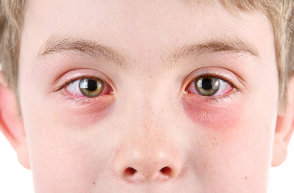 A close up image of a child suffering from eye irritation and a possible infection.