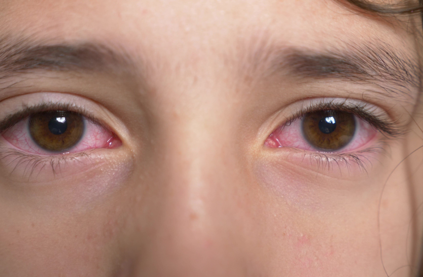 A close-up of a young child with redness in her eyes.