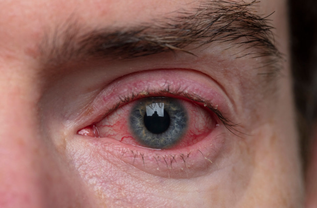 A close-up of an eye with pink eye.