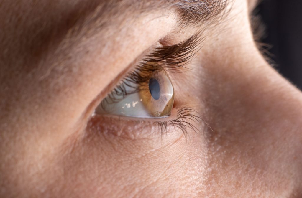 A close-up image of an eye with clear signs of keratoconus.