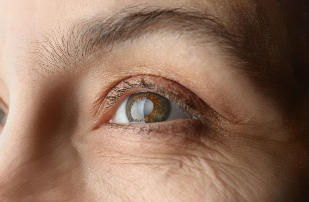 Close up of an individual’s brown eye that is greyed over from a cataract