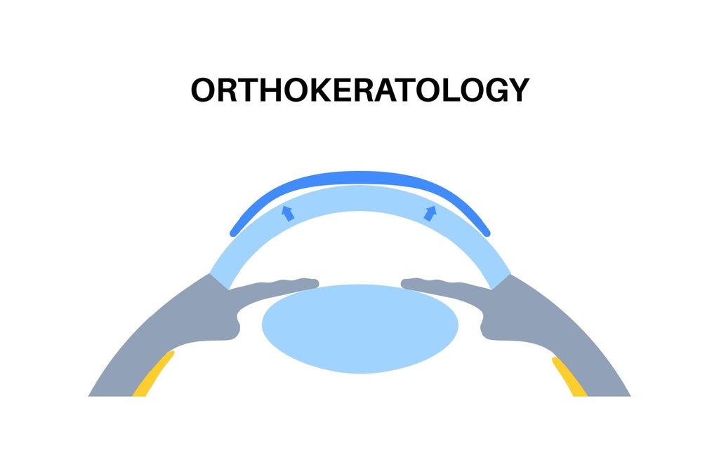 A diagram of an ortho-k contact lens  over a cornea.